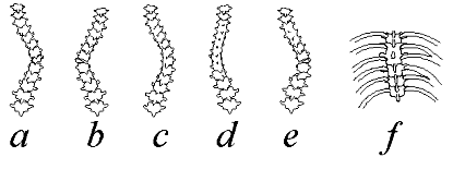 scoliosi1